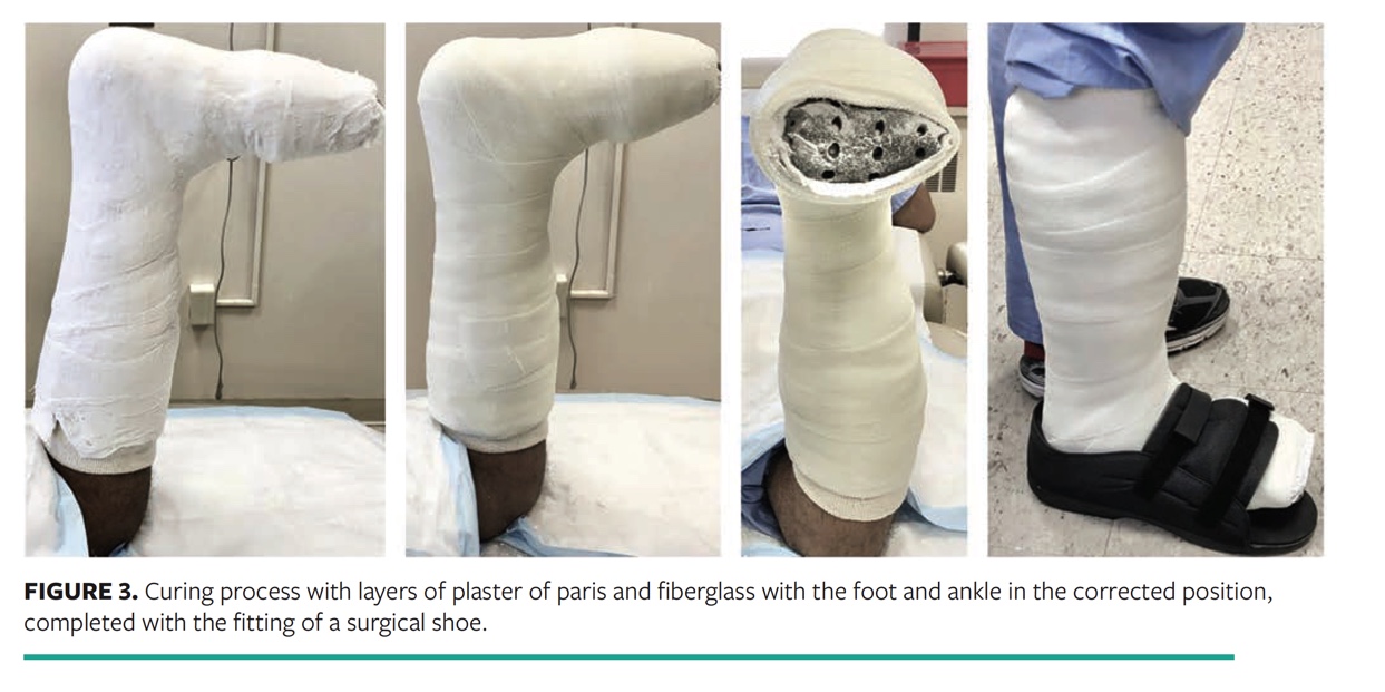 The Custom Total Contact Cast to Offload Foot Ulcers in the Presence of